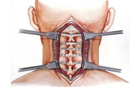 Cervical Spine Surgery