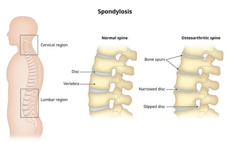 Cervical Spondylosis Treatment