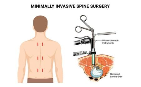 Minimal Invasive Spine Surgery