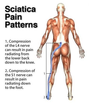 Sciatica Treatment