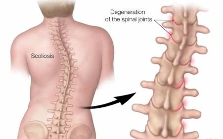 Scoliosis