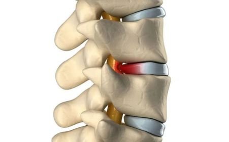 Posterior Disc Bulge