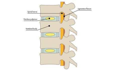 Lumbar Spondylosis