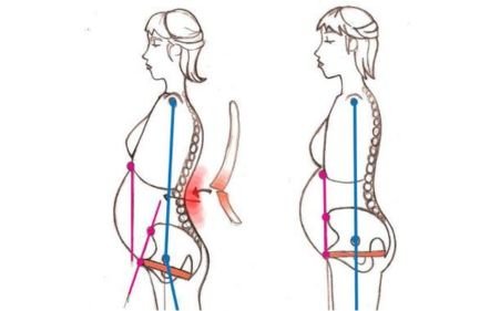 Low Back Pain During Pregnancy