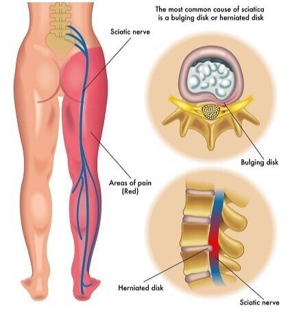 Sciatica Treatment