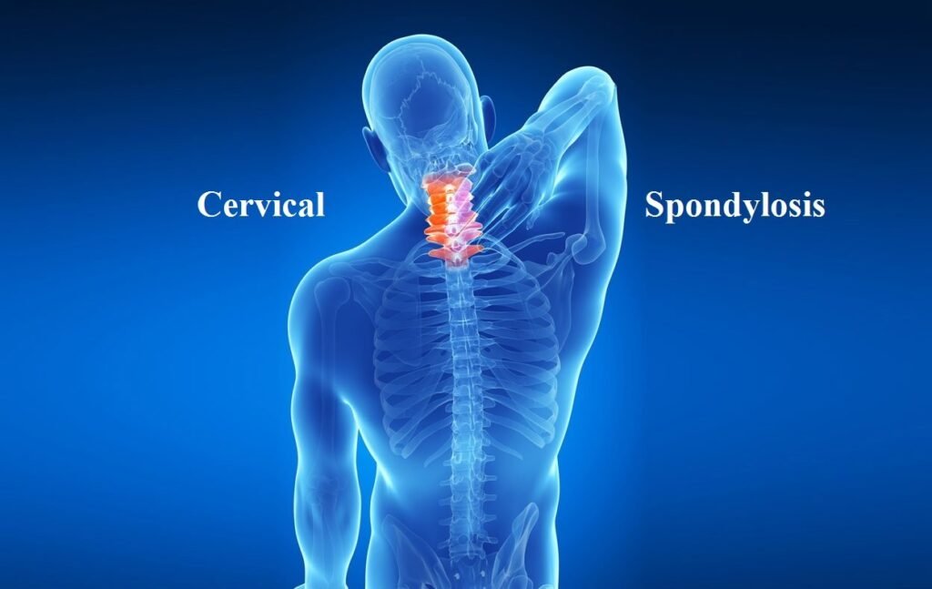 Cervical Spondylosis